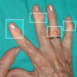 артрит пальцев рук симптомы и лечение народные средства
