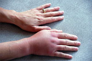 лечение артрита пальцев рук медикаментами
