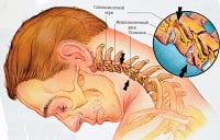 симптомы остеохондроза шейного отдела позвоночника