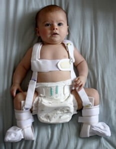 Изображение - Массаж тазобедренного сустава ребенку 3 месяца lechenie-displazii-tazobedrennogo-sustava-u-novorozhdennyh-233x300