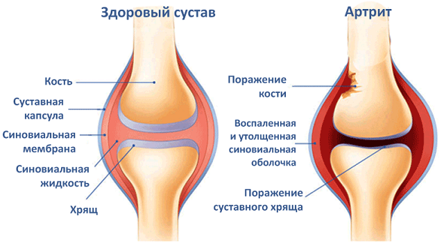 артрит коленного сустава симптомы и лечение