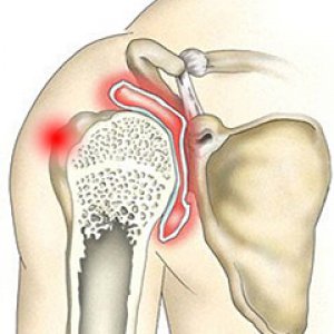 артрит плечевого сустава лечение